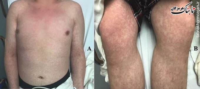 حدود دو هفته قبل یک کیس مبتلا به کووید۱۹ همراه با راش پوستی معرفی شد